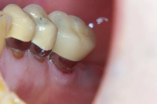 Có nhiều nguyên nhân bọc răng sứ hở 