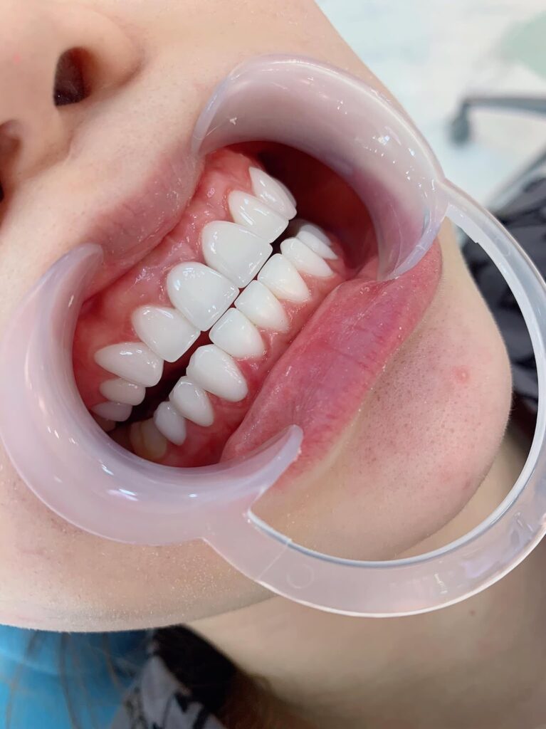 Chi phí răng sứ Cercon dao động 5.5 triệu đồng/răng