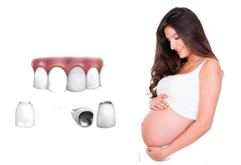 bọc răng sứ khi mang thai