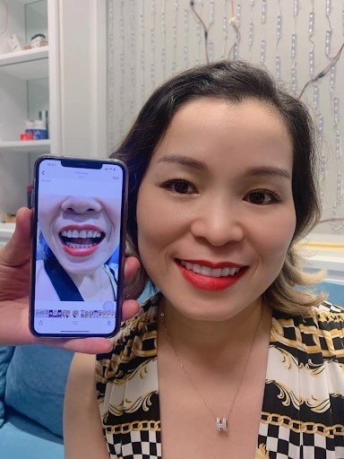 Hình ảnh trước và sau khi bọc răng sứ của khách hàng