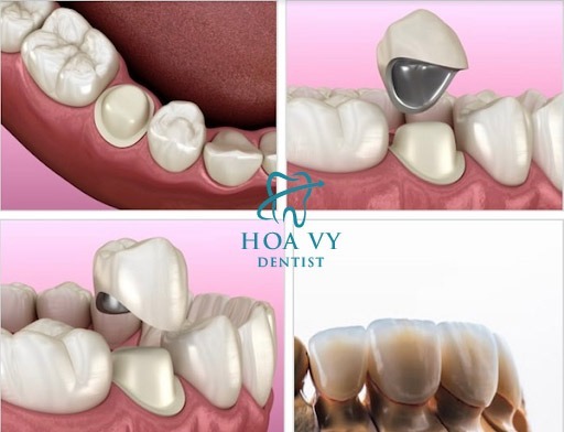 Răng sứ kim loại Titan giúp phục hồi răng chắc khỏe