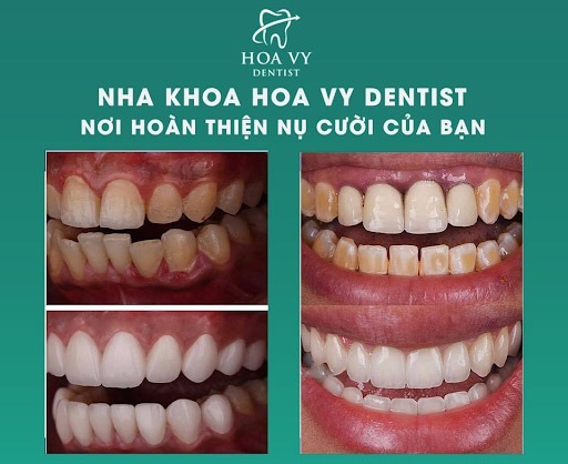 Răng bọc sứ thay đổi hoàn toàn nụ cười của bạn