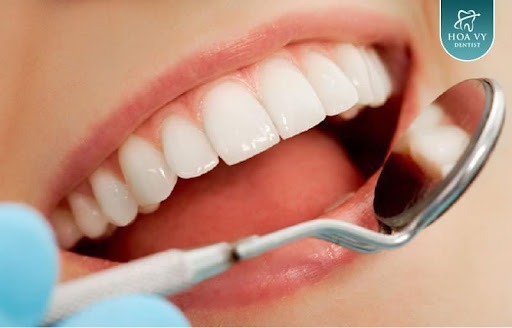 Tẩy trắng răng là cách sử dụng thuốc tẩy chuyên dụng để làm trắng 