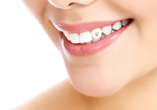 Có 2 phương pháp đính đá răng phổ biến 