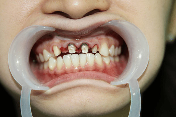 Biến chứng làm răng giả khi lựa chọn các cơ sở nha khoa kém chất lượng