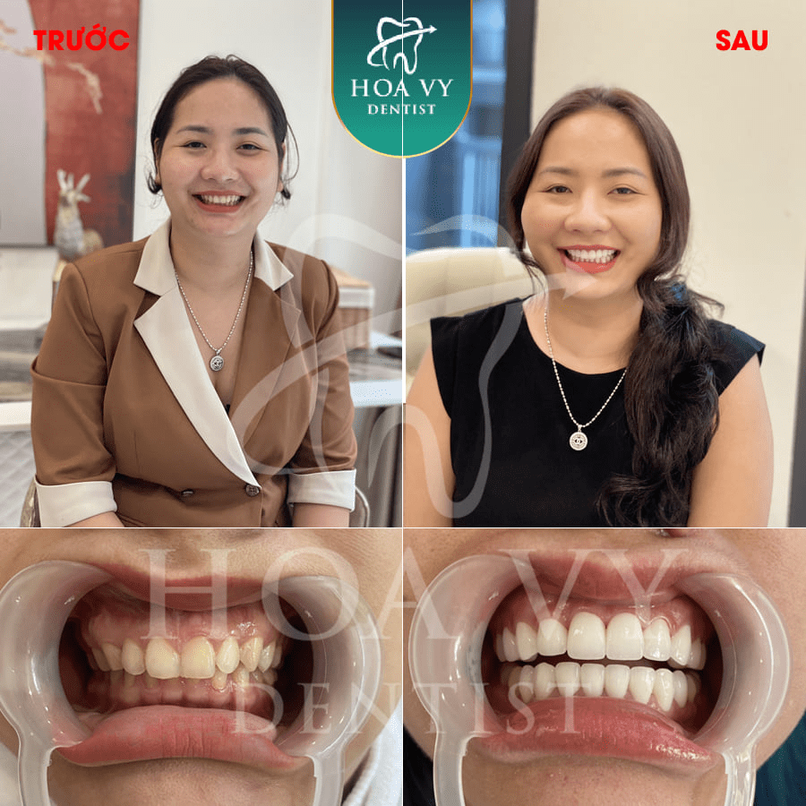 Hoa Vy Dentist là dịch vụ làm răng giả tại Hải Phòng được Bộ Y Tế cấp phép 
