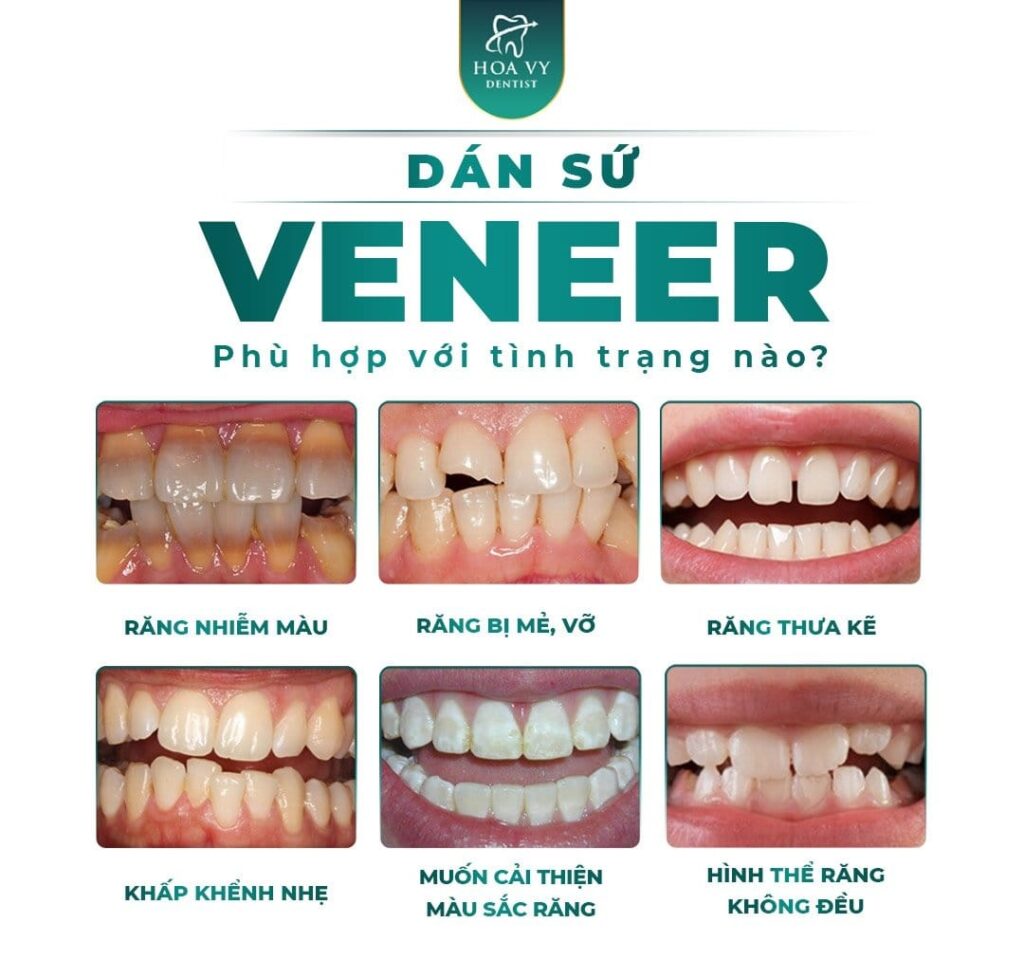 Dán sứ Veneer phù hợp với tình trạng răng nào?