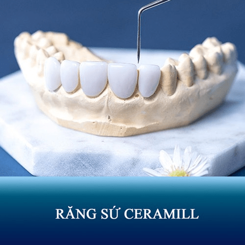 Răng sứ Ceramill mang đến rất nhiều ưu điểm vượt trội