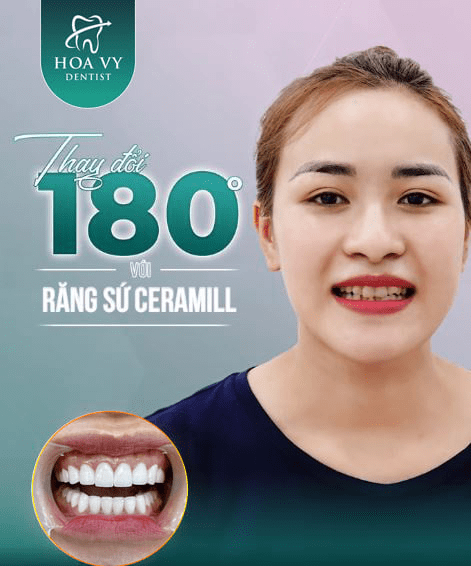 Bọc răng sứ Ceramill tại Nha khoa HoaVy Dentist