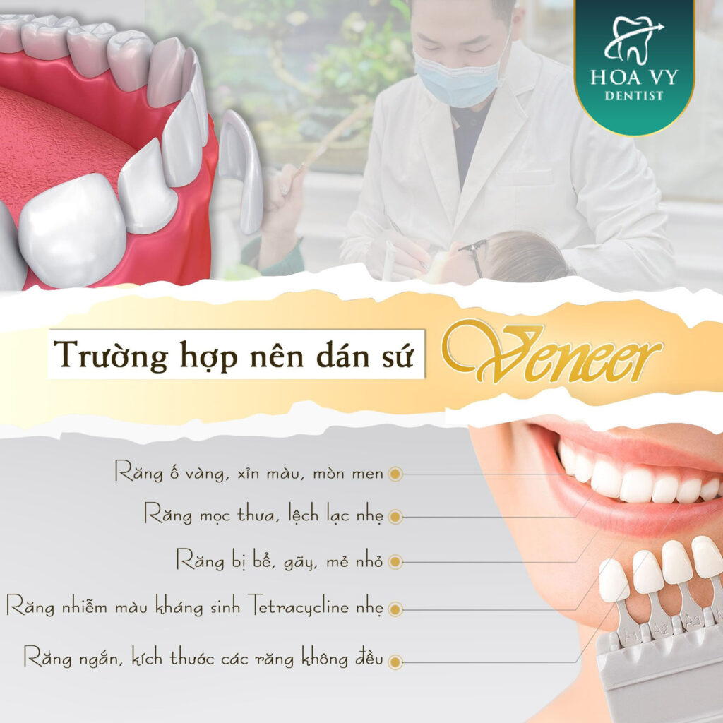 6 trường hợp nên dán răng sứ veneer