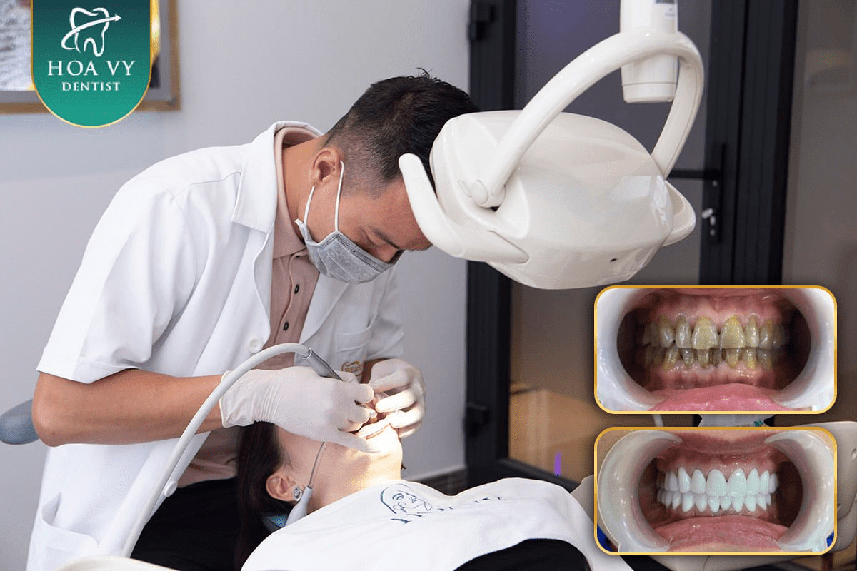 Bọc răng sứ đòi hỏi bác sĩ có tay nghề cao