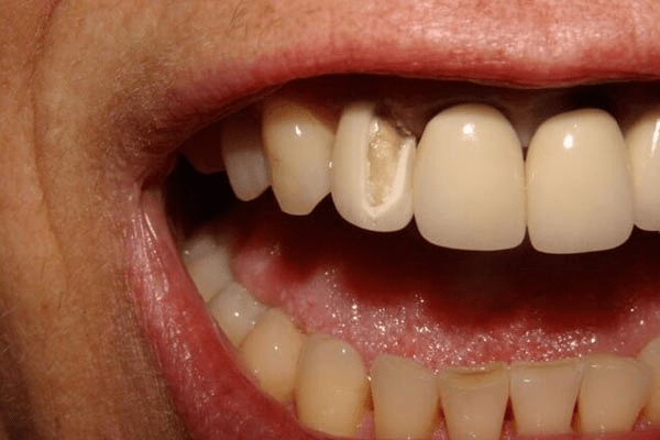 Răng sứ bị sứt mẻ có thể khiến khoang miệng bị chảy máu và mất thẩm mỹ.