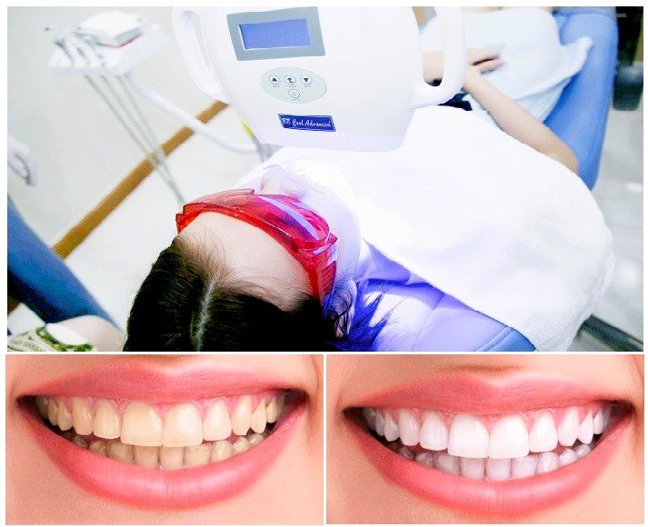 Tẩy trắng răng là dịch vụ được yêu thích tại Hoa Vy Dentist