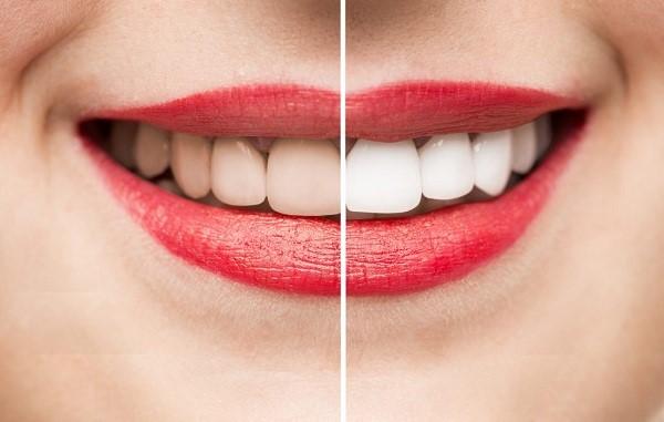 Dịch vụ tẩy trắng răng tại Nha khoa Hoa Vy giúp khách hàng có nụ cười trắng sáng