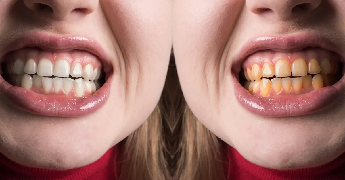 Luôn đảm bảo an toàn tuyệt đối 100% khi tẩy trắng răng
