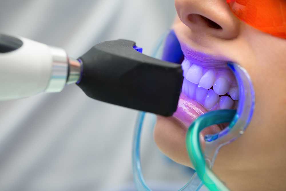  Kỹ thuật tẩy trắng răng tại Kiến Thụy của Hoavy Dentist hiện đại.