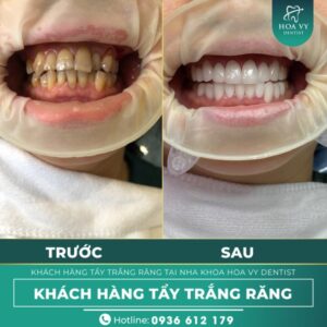 Lý do nên sử dụng dịch vụ tẩy trắng răng tại Hải An Hoa Vy Dentist?