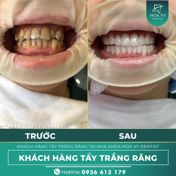 Hoa Vy Dentist là chuyên gia trong lĩnh vực nha khoa, với nhiều năm kinh nghiệm trong việc tẩy trắng răng 
