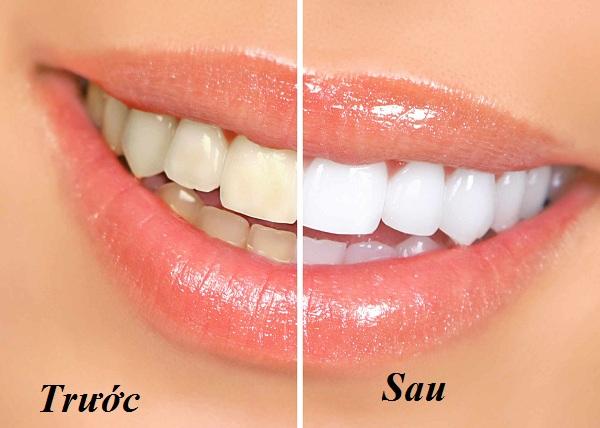 Tẩy trắng răng giúp loại bỏ nguy cơ mắc các bệnh về răng miệng