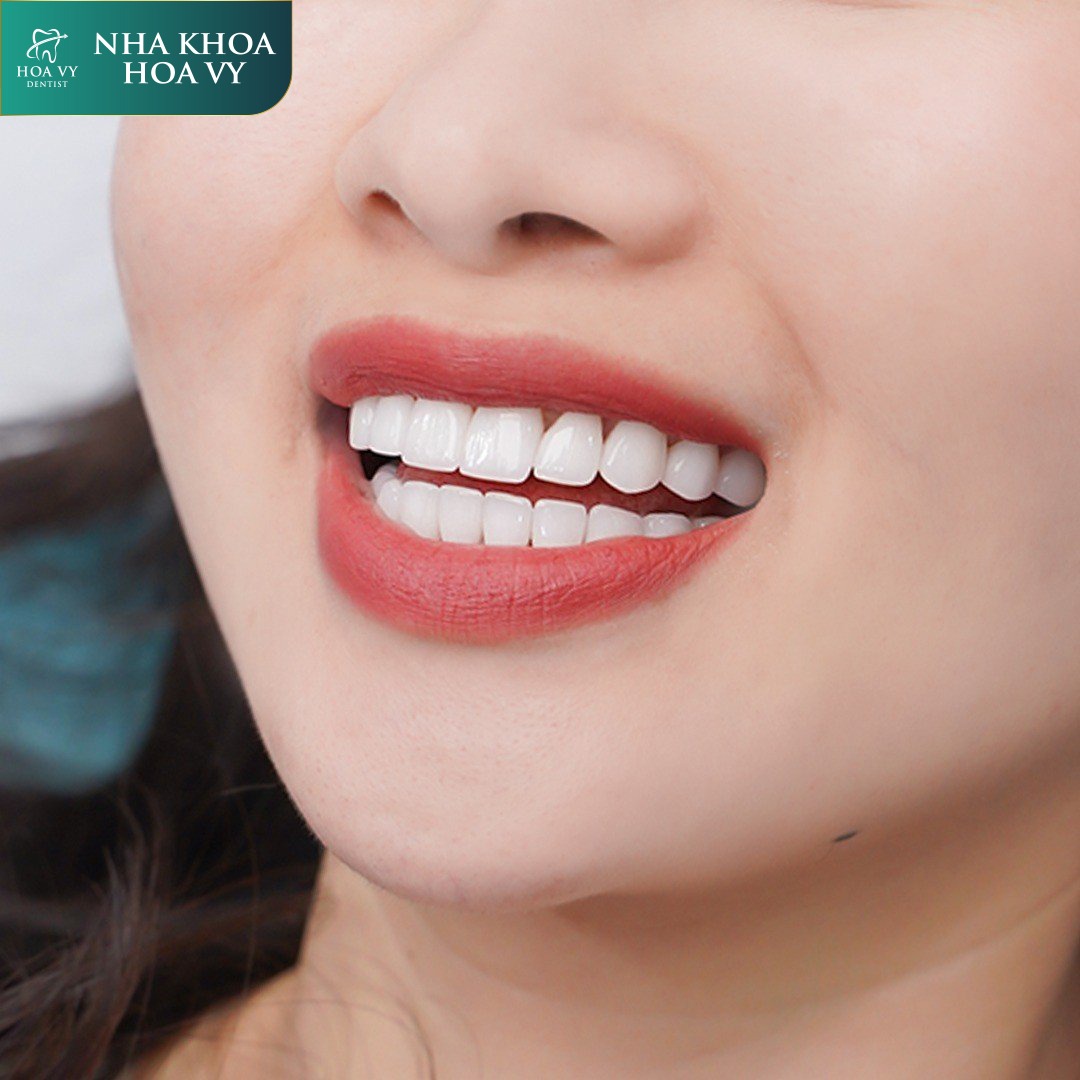 Răng sứ kim cương được coi là “siêu răng sứ” nhờ độ bền chắc và tính thẩm mỹ vượt trội, tái tạo giống răng thật 99%