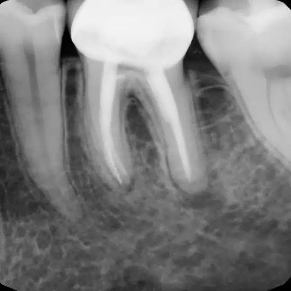 Hình ảnh X-quang cho thấy ổ nhiễm trùng xuất hiện quanh phần ống tủy do thân răng sứ bị rò rỉ ở mép ống tủy