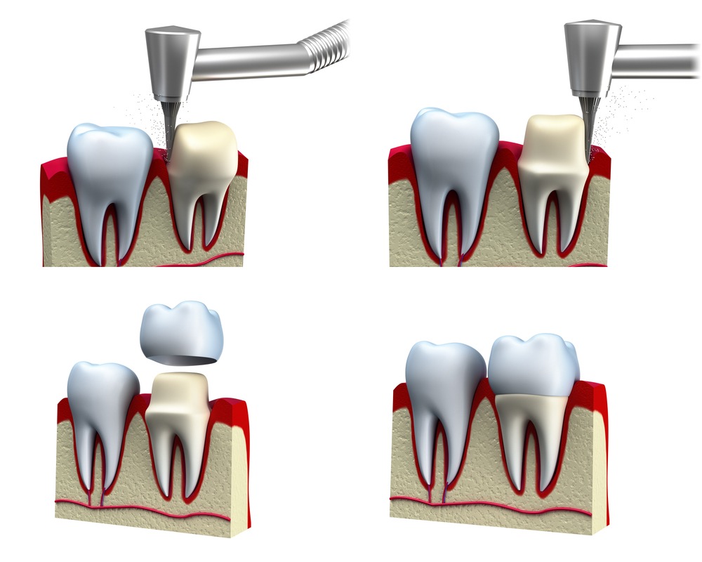 Quá trình mài răng để bọc sứ có thể gây ra các cơn đau buốt thần kinh dai dẳng