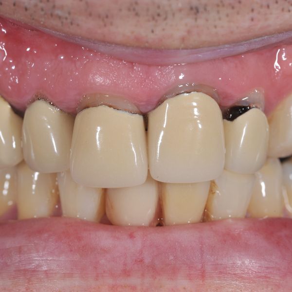 Hình ảnh viền nướu bị đen do răng sứ có thành phần kim loại bị oxy hóa, bị tụt nướu chân răng