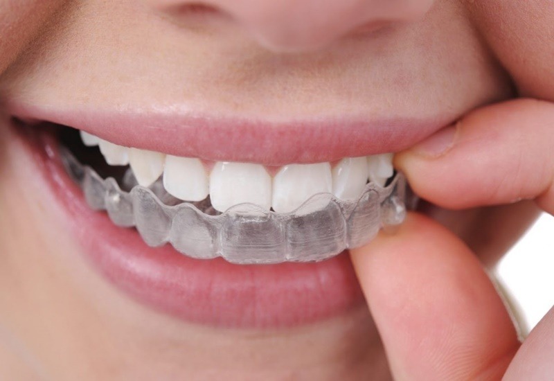 Tẩy trắng răng bằng máng tại nhà tốn thời gian hơn