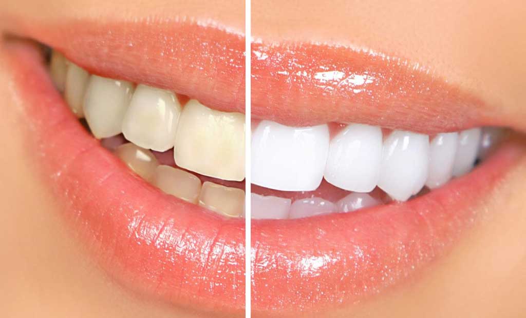 Tẩy trắng răng sẽ gặp rủi ro nếu như làm tại nha khoa kém chất lượng