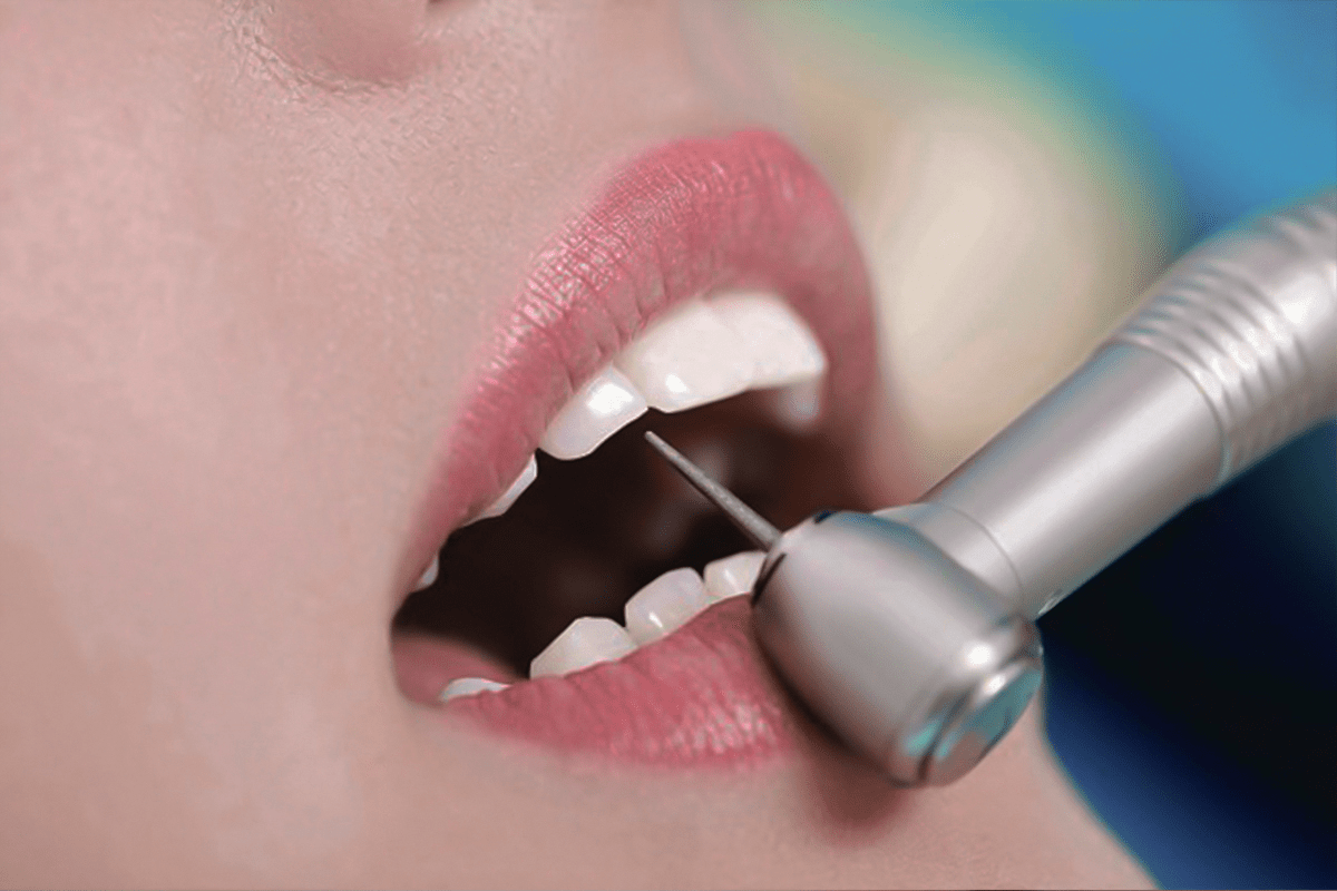 Mài răng bọc sứ có thể gây ê buốt nhẹ sau khi thực hiện 