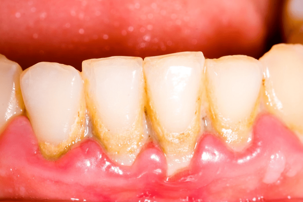 Nên chú ý giữ gìn vệ sinh răng miệng để tránh phải cạo vôi răng