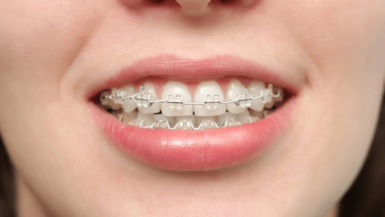 Đeo niềng răng là cách chữa răng mọc lệch phổ biến nhất hiện nay