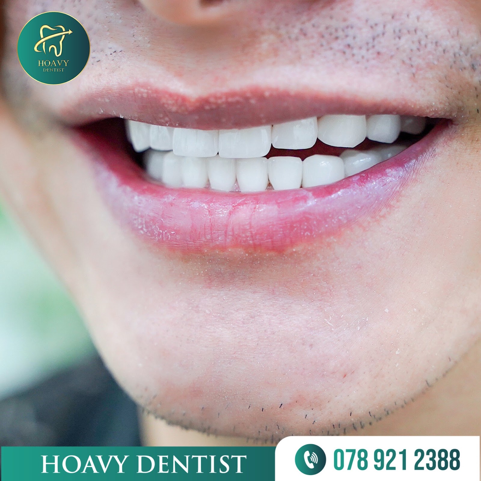 Hoavy Dentist có dịch vụ phục hình răng sứ cao cấp, bảo hành lâu dài