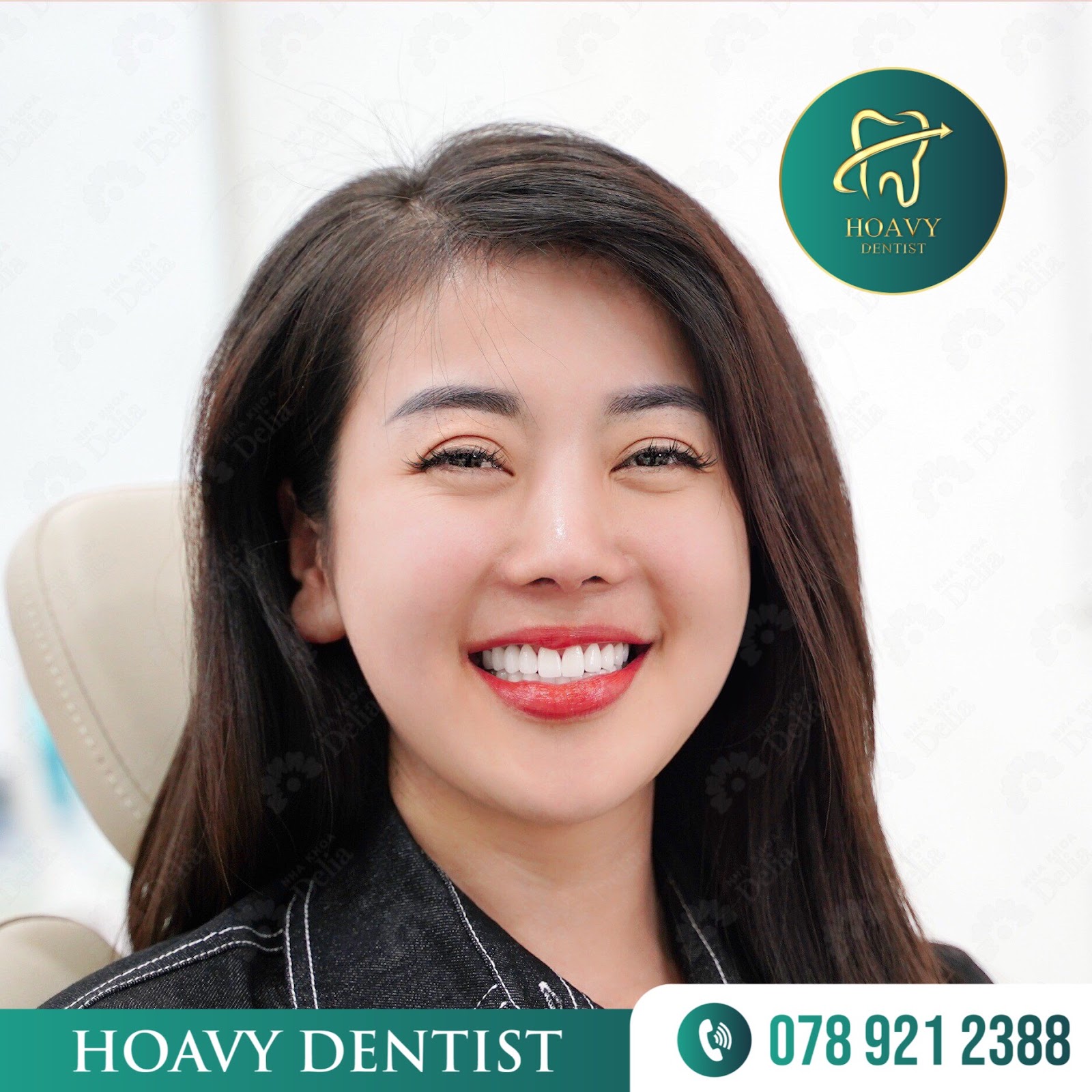 Hoavy Dentist có dịch vụ bọc răng sứ chữa cười hở lợi uy tín